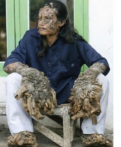 Papilloma