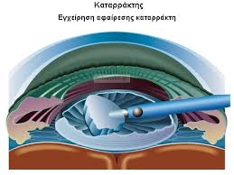 katarraktis