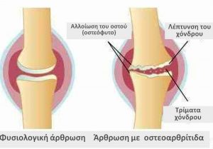 osteoarthritida