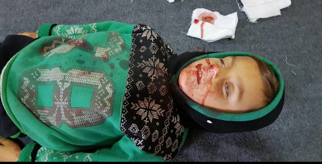 Σημερινή φωτογραφία από την κουρδική ιστοσελίδα Rojava News, ένα  αθώο παιδί θύμα της θηριωδίας των Τούρκων